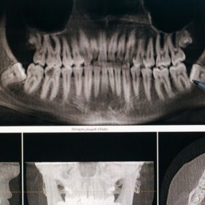 Bölcsességfog húzás: szakértő megoldások a MyDentnél