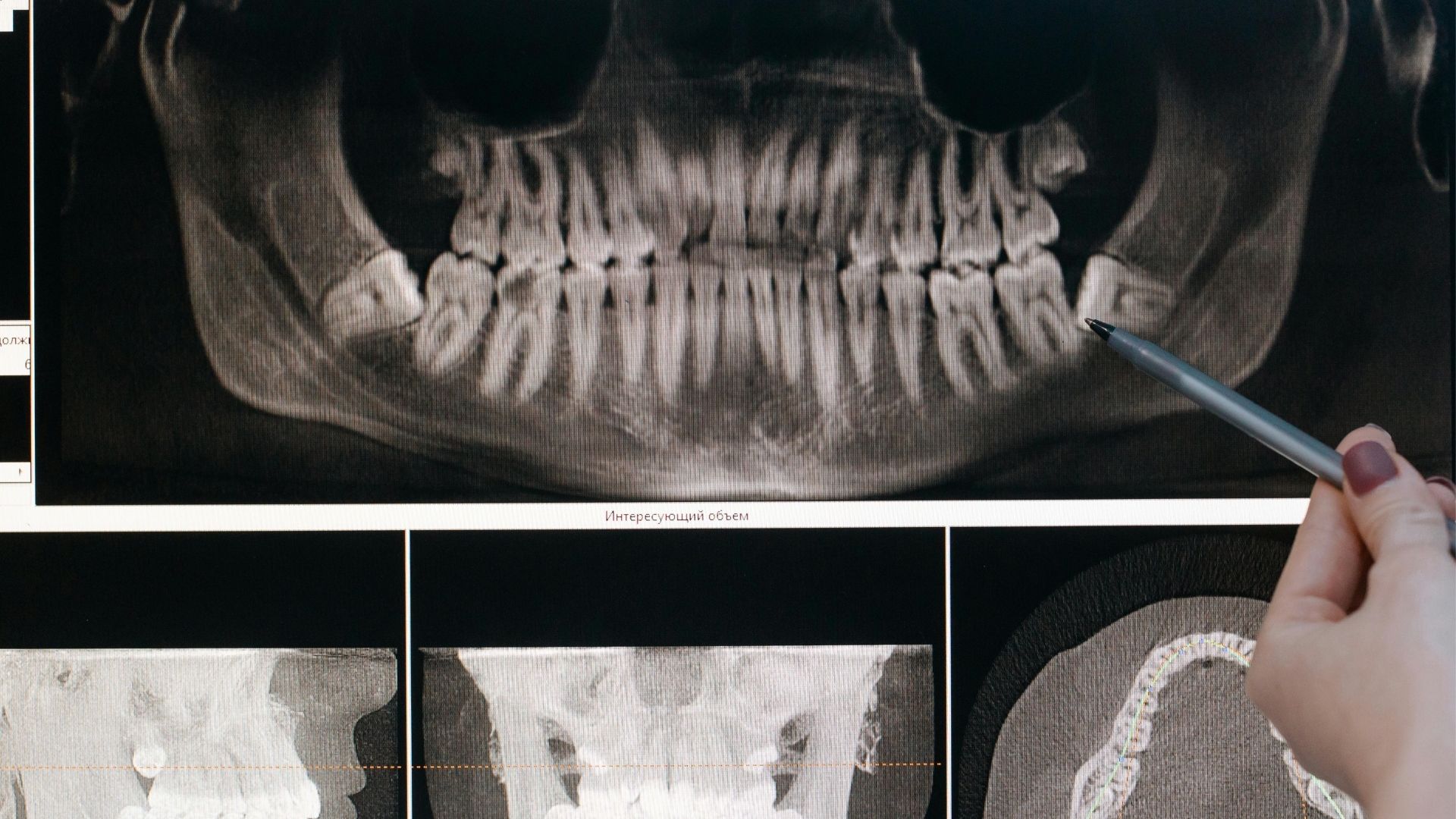 Bölcsességfog húzás: szakértő megoldások a MyDentnél